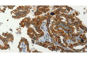 Immunohistochemistry of paraffin-embedded Human thyroid cancer using SERPINA9 Polyclonal Antibody at dilution of 1:60 (SERPINA9 Antikörper)