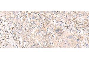 Immunohistochemistry of paraffin-embedded Human cervical cancer tissue using IL24 Polyclonal Antibody at dilution of 1:30(x200) (IL-24 Antikörper)