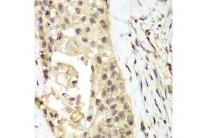 Immunohistochemistry of paraffin-embedded human lung cancer using FGFR1 antibody at dilution of 1:100 (400x lens). (FGFR1 Antikörper)