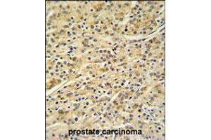 HOXA3 Antibody IHC analysis in formalin fixed and paraffin embedded prostate carcinoma followed by peroxidase conjugation of the secondary antibody and DAB staining. (HOXA3 Antikörper  (C-Term))