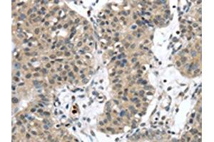 The image on the left is immunohistochemistry of paraffin-embedded Human breast cancer tissue using ABIN7192310(SENP6 Antibody) at dilution 1/20, on the right is treated with synthetic peptide. (SENP6 Antikörper)