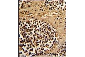 Formalin-fixed and paraffin-embedded human kidney carcinoma reacted with ESRRA Antibody (Center), which was peroxidase-conjugated to the secondary antibody, followed by DAB staining. (ESRRA Antikörper  (AA 131-159))