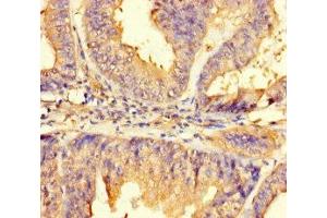 Immunohistochemistry of paraffin-embedded human endometrial cancer using ABIN7165645 at dilution of 1:100 (IMPACT Antikörper  (AA 41-320))