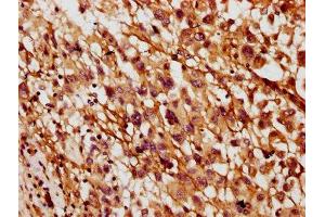 IHC image of ABIN7160617 diluted at 1:400 and staining in paraffin-embedded human melanoma performed on a Leica BondTM system. (MYO3B Antikörper  (AA 1110-1276))