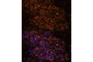 Immunofluorescence analysis of human kidney cancer using SCNN1G antibody (ABIN7270387) at dilution of 1:100. (SCNN1G Antikörper  (AA 100-250))