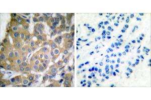 Peptide - +Immunohistochemical analysis of paraffin-embedded human breast carcinoma tissue using Cox2 antibody. (COX2 Antikörper)