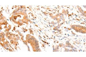 Immunohistochemistry of paraffin-embedded Human colon cancer tissue using ABCA4 Polyclonal Antibody at dilution of 1:30 (ABCA4 Antikörper)