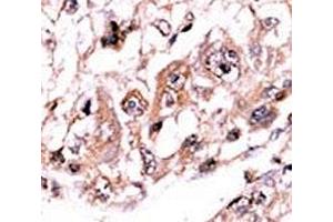 IHC analysis of FFPE human hepatocarcinoma stained with the PPP3CC antibody