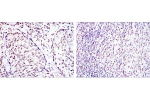 Immunohistochemical analysis of paraffin-embedded prostate cancer tissues (left) and submaxillary tumor tissues (right) using CREB1 mouse mAb with DAB staining.