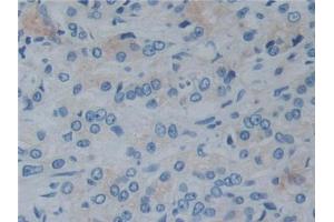 IHC-P analysis of Human Prostate cancer Tissue, with DAB staining. (Reelin Antikörper  (AA 2398-2608))