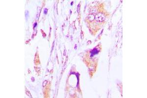 Immunohistochemical analysis of IgG1 staining in human lung cancer formalin fixed paraffin embedded tissue section.