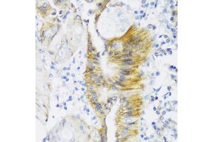 Immunohistochemistry of paraffin-embedded human colon carcinoma using CLDN4 antibody (ABIN6133648, ABIN6138690, ABIN6138691 and ABIN6216719) at dilution of 1:150 (40x lens). (Claudin 4 Antikörper  (C-Term))