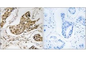 Immunohistochemistry analysis of paraffin-embedded human breast carcinoma tissue, using RTCD1 Antibody. (RTCD1 Antikörper  (AA 317-366))