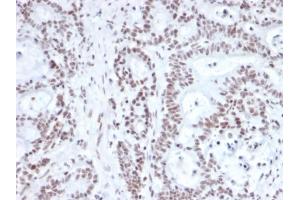 Formalin-fixed, paraffin-embedded human prostate carcinoma stained with NRF1 Mouse Monoclonal Antibody (NRF1/2609).