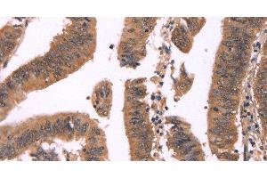 Immunohistochemistry of paraffin-embedded Human colon cancer tissue using FBXO31 Polyclonal Antibody at dilution 1:40 (FBXO31 Antikörper)