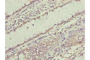 Immunohistochemistry of paraffin-embedded human colon cancer using ABIN7168238 at dilution of 1:100