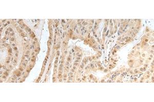 Immunohistochemistry of paraffin-embedded Human thyroid cancer tissue using ZNF24 Polyclonal Antibody at dilution of 1:35(x200) (ZNF24 Antikörper)