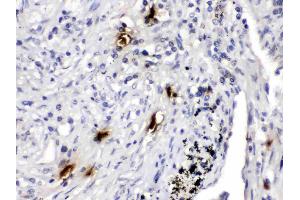 Mast Cell Tryptase was detected in paraffin-embedded sections of human lung cancer tissues using rabbit anti- Mast Cell Tryptase Antigen Affinity purified polyclonal antibody (Catalog # ) at 1 µg/mL. (TPSAB1 Antikörper  (AA 65-275))