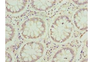 Immunohistochemistry of paraffin-embedded human colon cancer using ABIN7165668 at dilution of 1:100