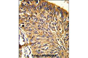 Formalin-fixed and paraffin-embedded human lung carcinoma reacted with PRDX3 Antibody (N-term), which was peroxidase-conjugated to the secondary antibody, followed by DAB staining. (Peroxiredoxin 3 Antikörper  (N-Term))