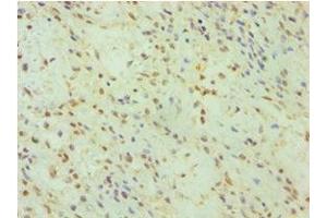 Immunohistochemistry of paraffin-embedded human breast cancer using ABIN7153663 at dilution of 1:100 (Non-Syndromic Hearing Impairment Protein 5 (GSDME) (AA 1-260) Antikörper)
