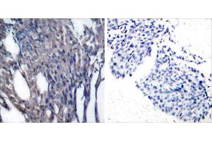 P-Peptide - +Immunohistochemical analysis of paraffin-embedded human breast carcinoma tissue using IκB-α (phospho-Tyr42) antibody. (NFKBIA Antikörper  (pTyr42))