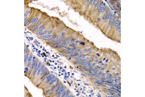 Immunohistochemistry of paraffin-embedded human colon cancer using IL9 antibody (ABIN3015677, ABIN3015678, ABIN1680463 and ABIN6219030) at dilution of 1:200 (40x lens). (IL-9 Antikörper  (AA 19-144))