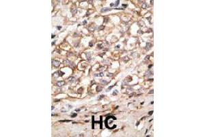 Formalin-fixed and paraffin-embedded human hepatocellular carcinoma tissue reacted with SIGLEC11 polyclonal antibody  , which was peroxidase-conjugated to the secondary antibody, followed by AEC staining. (SIGLEC11 Antikörper  (C-Term))
