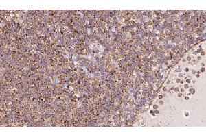 ABIN6273181 at 1/100 staining Human lymph cancer tissue by IHC-P. (TRIM9 Antikörper  (N-Term))