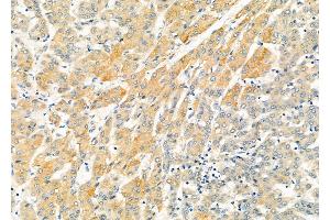 ABIN6265622 and ABIN6273178 at 1/100 staining Human liver cancer by IHC-P. (TMSB4X Antikörper  (N-Term))