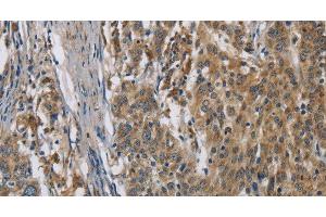 Immunohistochemistry of paraffin-embedded Human gastic cancer using SIGMAR1 Polyclonal Antibody at dilution of 1:50 (SIGMAR1 Antikörper)