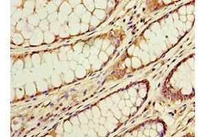 Immunohistochemistry of paraffin-embedded human colon cancer using ABIN7143228 at dilution of 1:100 (ACSM3 Antikörper  (AA 387-586))