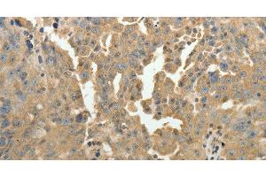 Immunohistochemistry of paraffin-embedded Human ovarian cancer using PSMD9 Polyclonal Antibody at dilution of 1:50 (PSMD9 Antikörper)