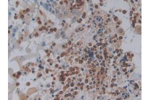 Detection of FOS in Human Skin cancer Tissue using Polyclonal Antibody to V-Fos FBJ Murine Osteosarcoma Viral Oncogene Homolog (FOS) (FOS Antikörper  (AA 55-298))