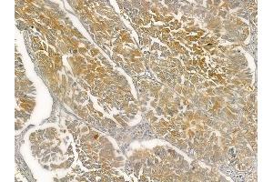 ABIN6257069 and ABIN6274978 at 1/100 staining human lung squamous cell carcinoma by IHC-P. (CNOT4 Antikörper  (N-Term))