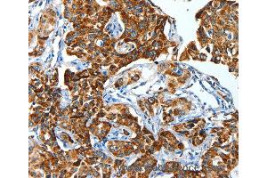 Immunohistochemistry of Human lung cancer using ALDH6A1 Polyclonal Antibody at dilution of 1:45 (ALDH6A1 Antikörper)