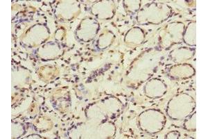 Immunohistochemistry of paraffin-embedded human gastric cancer using ABIN7154322 at dilution of 1:100 (GBF1 Antikörper  (AA 1-85))