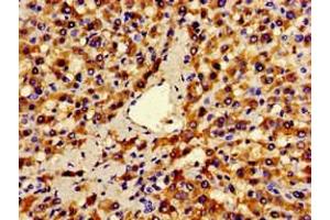 Immunohistochemistry of paraffin-embedded human liver cancer using ABIN7144300 at dilution of 1:100 (ANO1 Antikörper  (AA 1-151))