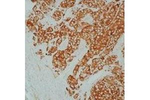 Formalin-fixed, paraffin-embedded  human breast carcinoma stained with Heat Shock Protein 27  using peroxidase-  conjugate and DAB chromogen. (HSP27 Antikörper)