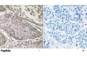 Immunohistochemistry analysis of paraffin-embedded human lung carcinoma tissue using PLA2G4E polyclonal antibody . (PLA2G4E Antikörper)