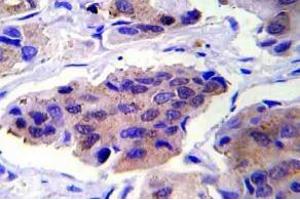 Immunohistochemistry (IHC) analyzes of GSK3alpha pAb in paraffin-embedded human breast carcinoma tissue. (GSK3 alpha Antikörper)