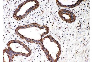 Anti-Smad2 antibody, IHC(P) IHC(P): Human Mammary Cancer Tissue (SMAD2 Antikörper  (N-Term))