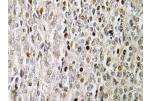 Immunohistochemistry analyses of FOXE3 in human prostate carcinoma tissue (Formalin-fixed, Paraffin-embedded) using FOXE3 / FKHL12 antibody . (FOXE3 Antikörper)