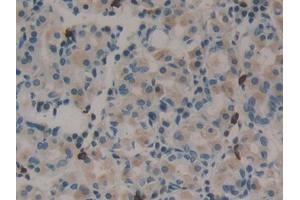 IHC-P analysis of Human Stomach cancer Tissue, with DAB staining. (Midkine Antikörper  (AA 22-143))