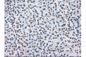Immunohistochemical staining of paraffin-embedded Adenocarcinoma of ovary tissue using anti-CHEK2mouse monoclonal antibody. (CHEK2 Antikörper)