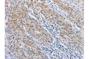 The image on the left is immunohistochemistry of paraffin-embedded Human gastric cancer tissue using ABIN7189712(AGAP2 Antibody) at dilution 1/30, on the right is treated with synthetic peptide. (AGAP2 Antikörper)