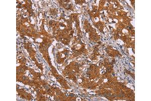 Immunohistochemistry of Human breast cancer using DCTN6 Polyclonal Antibody at dilution of 1:40 (DCTN6 Antikörper)