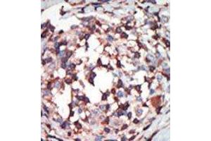 Formalin-fixed and paraffin-embedded human cancer tissue reacted with the primary antibody, which was peroxidase-conjugated to the secondary antibody, followed by AEC staining. (PKC beta Antikörper  (C-Term))