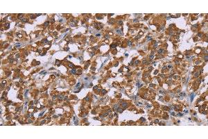Immunohistochemistry of paraffin-embedded Human thyroid cancer using Cyclophilin F Polyclonal Antibody at dilution of 1:45 (PPIF Antikörper)