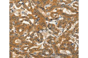 Immunohistochemistry of Human thyroid cancer using ADCY3 Polyclonal Antibody at dilution of 1:50 (ADCY3 Antikörper)